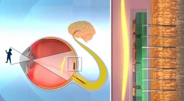 Bio-Retina retinal implant, diagram
